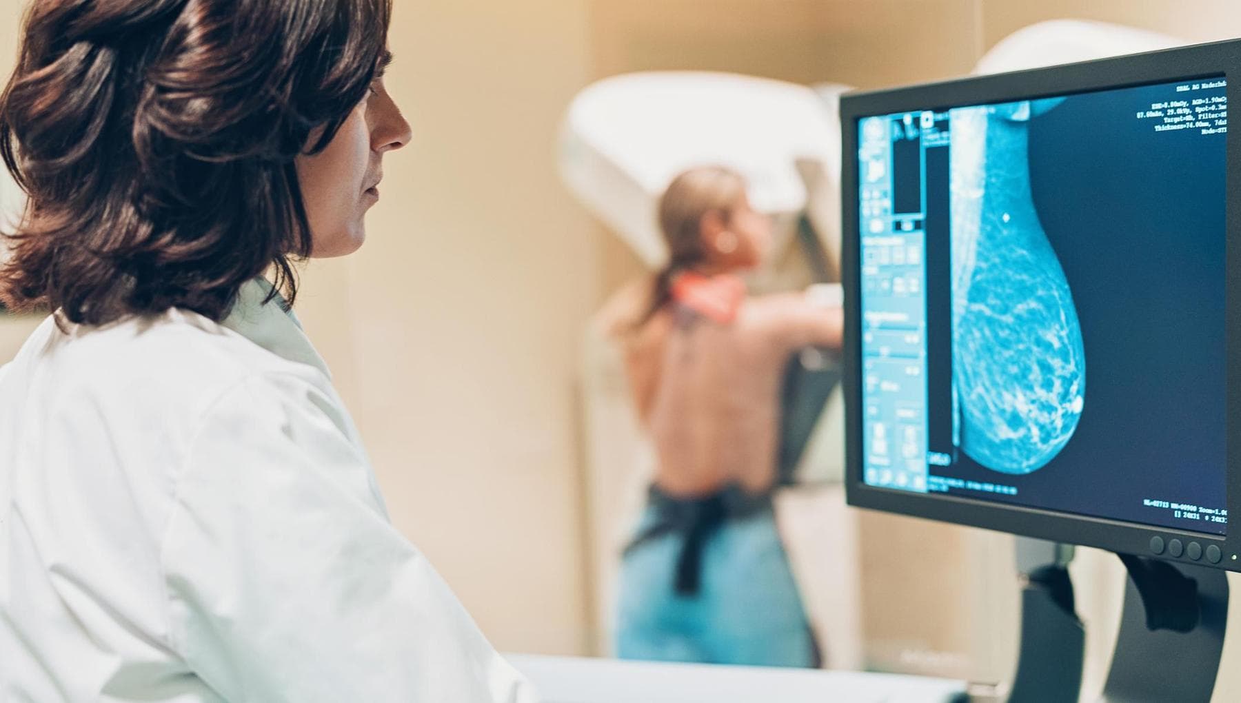 Cancer du sein, ce qui change avec les nouveaux niveaux d'aide indispensables