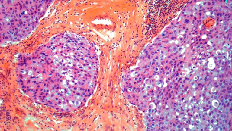 Cancer du sein : moins de rechutes et une survie accrue grâce à la thérapie combinée


